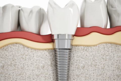 dental implants in Monroe