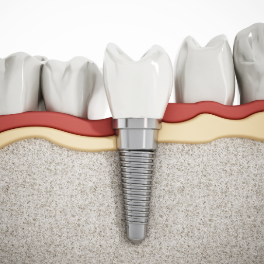 dental implants in Monroe