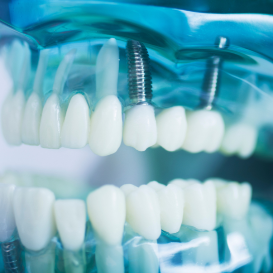 dental implants in fort gratiot